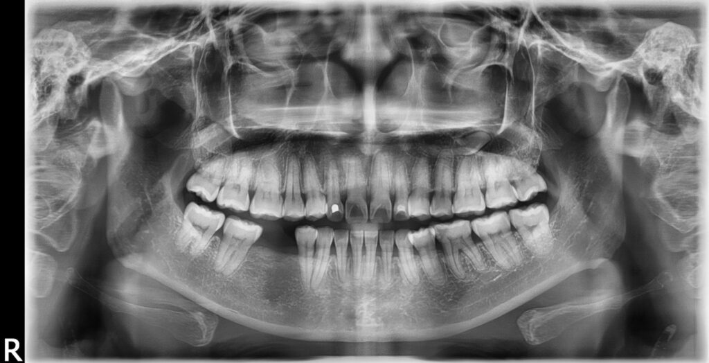 OPG dental scan, Orthopantomogram dental x-ray, Full mouth dental x-ray, OPG imaging in dentistry, Dental panoramic radiograph, OPG x-ray procedure, Jaw bone x-ray, Dental diagnostics with OPG,