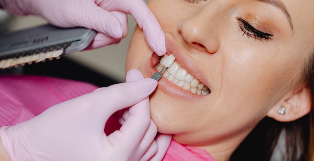 Dental veneers before and after, Porcelain veneers results, Composite veneers transformation, Veneers smile makeover, Veneers before and after photos, Cosmetic dental veneers, Teeth veneers results, Veneers for chipped teeth