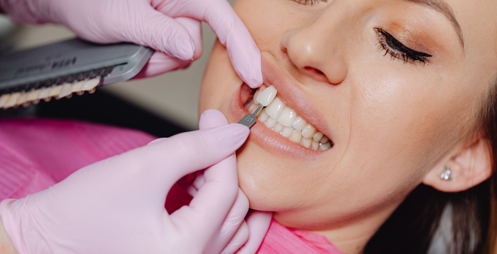 Dental veneers before and after, Porcelain veneers results, Composite veneers transformation, Veneers smile makeover, Veneers before and after photos, Cosmetic dental veneers, Teeth veneers results, Veneers for chipped teeth