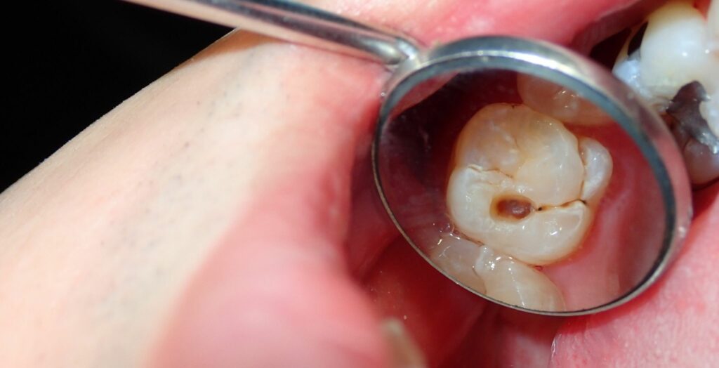 How to reverse tooth cavity, Natural ways to heal cavities, Remineralizing tooth enamel, Reverse early stage cavities, Preventing tooth decay naturally, Healing cavities without drilling, Tooth cavity reversal methods,